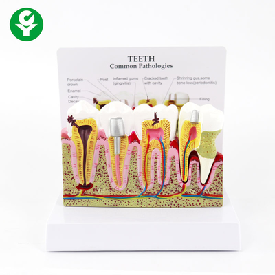 Affichage commun de pathologies de dents de délabrement médical humain dentaire périodontique de modèle
